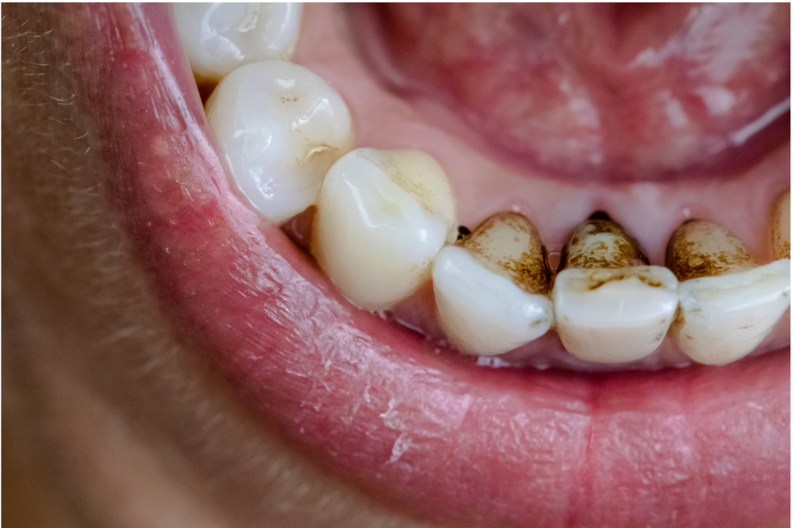 健康を害する前に知りたい！プラークと歯石について | ANDELT