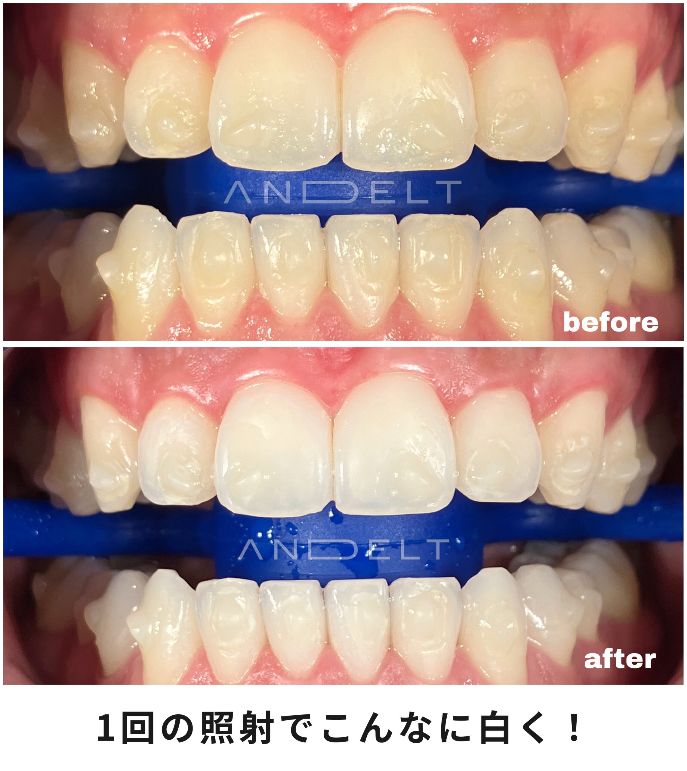 ホワイトニングの施術前・施術後